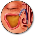 balloon sinus.jpg
